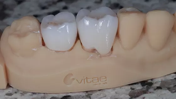 Lente de Contato Dental em Goiânia: alcance seu sorriso dos sonhos com a Estética Vitae 