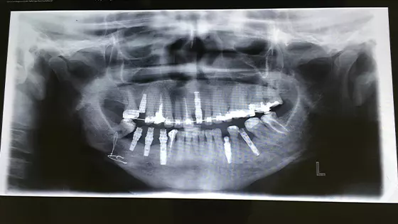 Oclusão Funcional em Goiânia: recupere sua saúde bucal com mais estabilidade para o seu sorriso