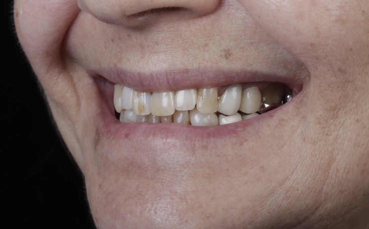 Mulher sorrindo com os dentes desgastados.