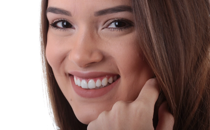 Mulher exibindo um belo sorriso com facetas de resina.