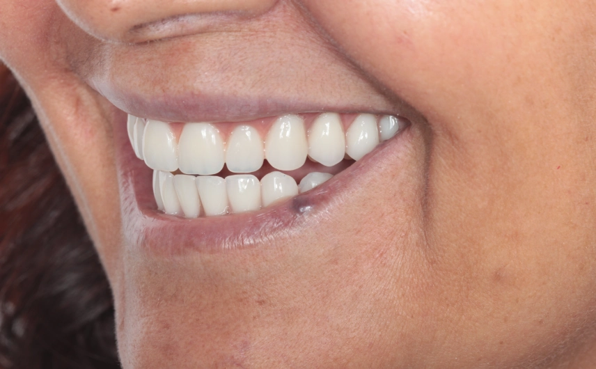 Mulher exibe o sorriso após realização de implante dentário.