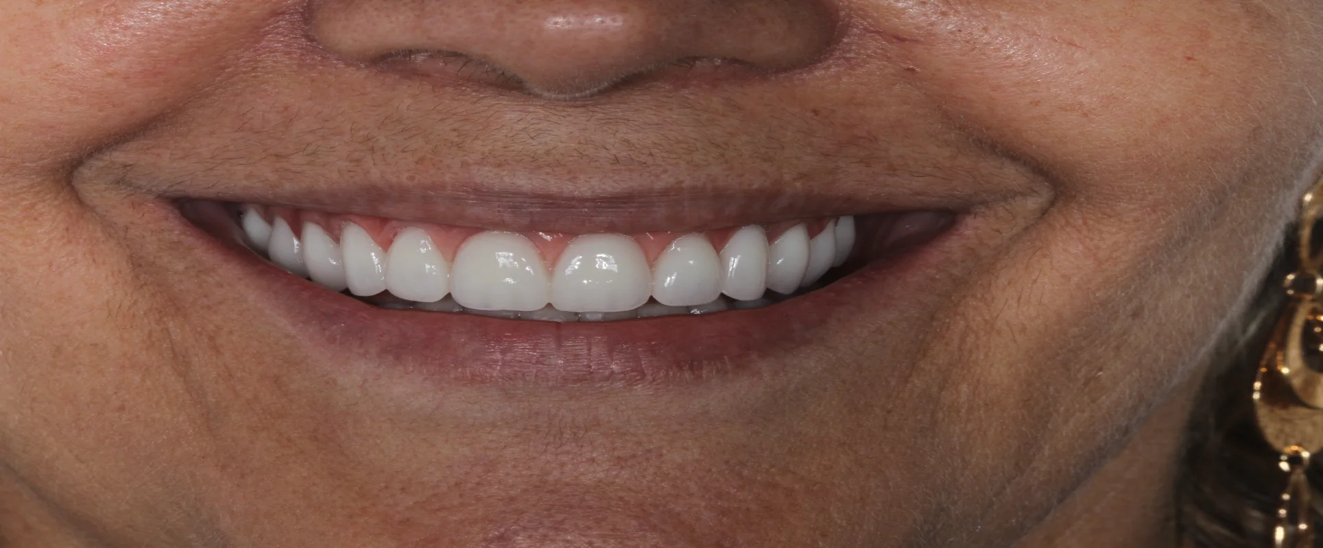  Imagem de dentes brancos com prótese dentária, exibindo o sorriso de uma paciente mulher da Estética Vitae.