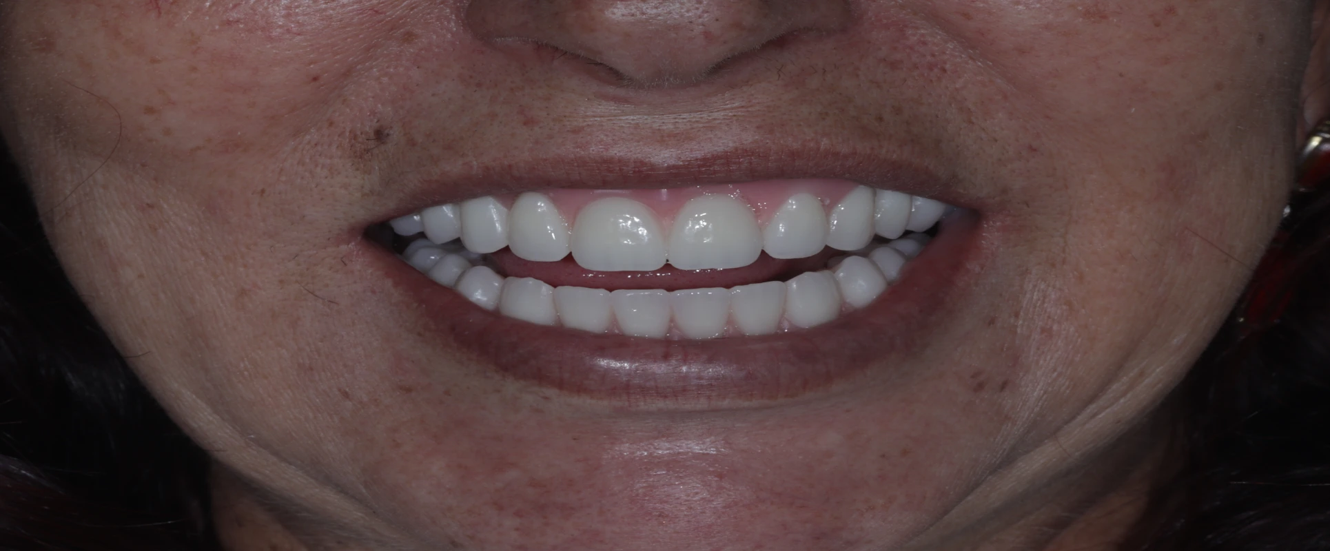 Imagem de uma mulher sorrindo após realizar procedimento de Implante Dentário na Estética Vitae em Goiânia.