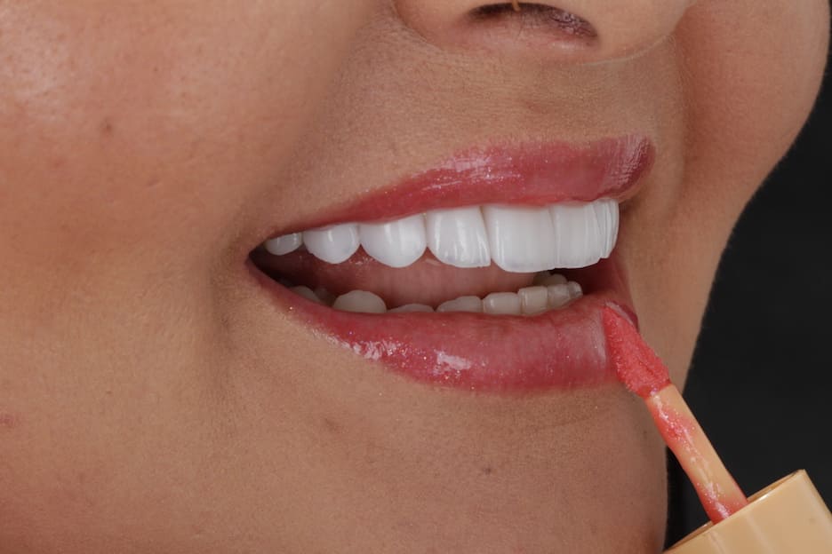 Sorriso da paciente da estática Vitae em Goiânia 